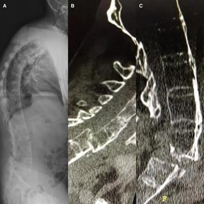 One-stage surgery by a halo-vest to treat simultaneous double spine fractures–dislocation in a patient with ankylosing spondylitis: case report and review of literature